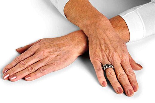 Koža rúk so zmenami súvisiacimi s vekom, ktoré si vyžadujú použitie omladzovacích techník
