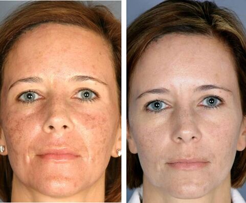 Pred a po frakčnej termolýze tváre