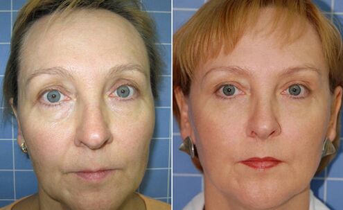 Pred a po frakčnom laserovom omladení tváre