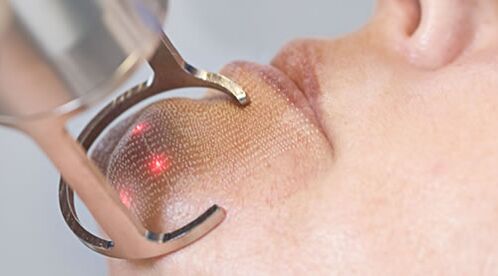 Priebeh postupu pre frakčné laserové omladenie pokožky tváre